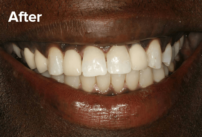 Dental Implants